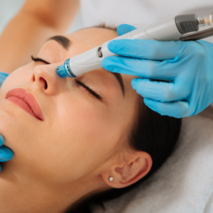 Chemical Peel for Pimples: Benefits, Types, Procedure, and What to Expect