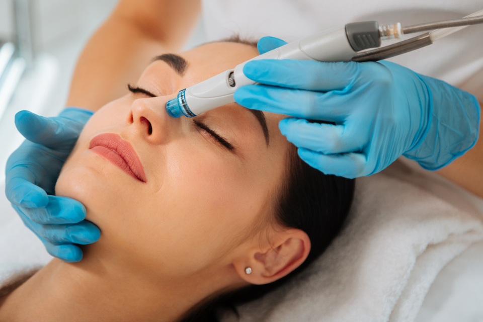 Chemical Peel for Pigmentation