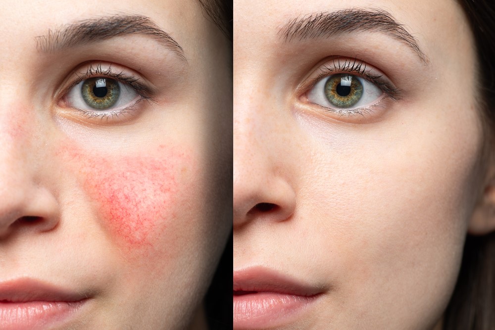 Sculptra vs. Angle Sculptra: Longevity, Cost, and Look