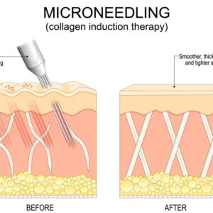 What to Expect from PRF Microneedling: Pain, Peeling, and Results by Week 1–6