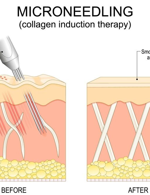 Cost & Value: Is PRF Microneedling Worth It for Acne Scars?