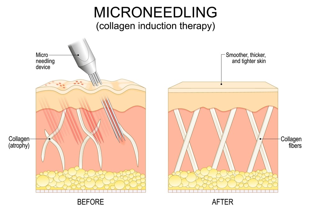 Cost & Value: Is PRF Microneedling Worth It for Acne Scars?