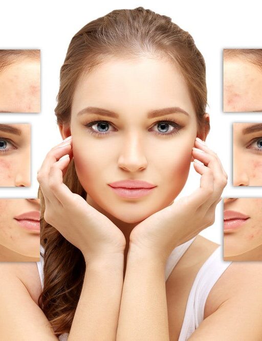 How to Treat Acne Scars: Top 4 Med Spa Treatments for Smooth Skin