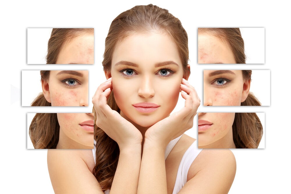 How to Treat Acne Scars: Top 4 Med Spa Treatments for Smooth Skin