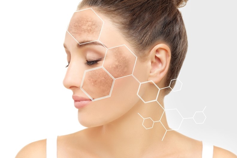 Hyperpigmentation 101: Causes, Prevention, and Top Treatment Options
