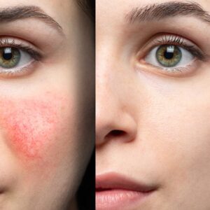 The VI Peel: A Comprehensive Guide to This Popular Chemical Peel