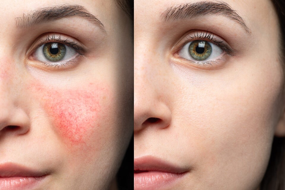Redness and Rosacea: Tips to Calm Blushing Skin and Reduce Redness