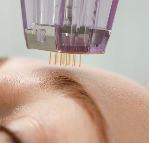 PRF Microneedling: Your 12-Week Transformation Timeline