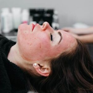 Neck & Décolletage Microneedling: Why Your Skin Needs the Full Picture